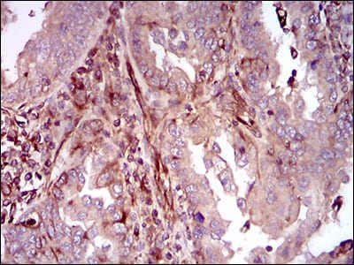 Figure 5: Immunohistochemical analysis of paraffin-embedded endometrial cancer tissues using MAPK14 mouse mAb with DAB staining.