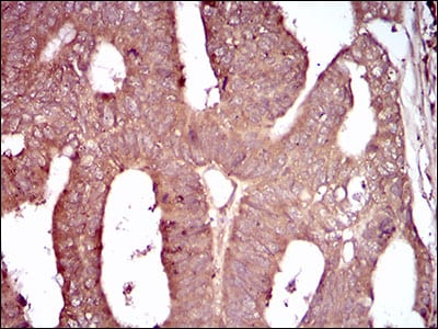 Figure 3: Immunohistochemical analysis of paraffin-embedded rectum cancer tissues using CD93 mouse mAb with DAB staining.