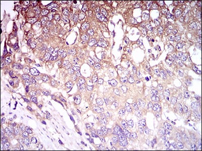 Figure 4: Immunohistochemical analysis of paraffin-embedded esophageal cancer tissues using CD93 mouse mAb with DAB staining.