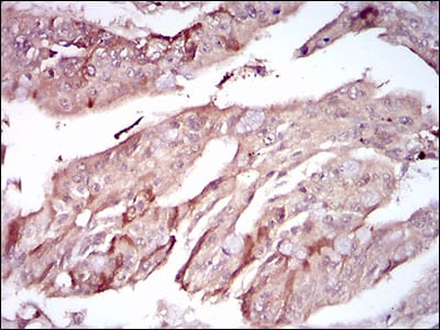 Figure 5: Immunohistochemical analysis of paraffin-embedded rectum cancer tissues using PON1 mouse mAb with DAB staining.