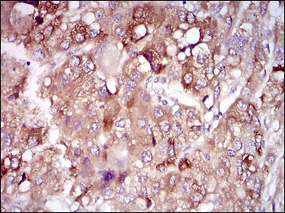 Figure 6: Immunohistochemical analysis of paraffin-embedded liver cancer tissues using PON1 mouse mAb with DAB staining.