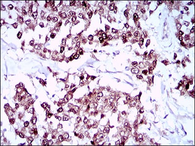 Figure 3: Immunohistochemical analysis of paraffin-embedded breast cancer tissues using SOX10 mouse mAb with DAB staining.