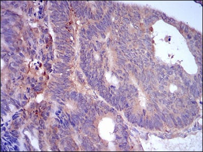 Figure 6: Immunohistochemical analysis of paraffin-embedded rectum cancer tissues using PLIN2 mouse mAb with DAB staining.