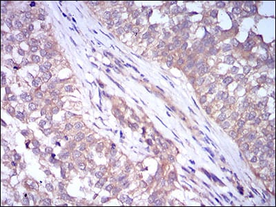 Figure 7: Immunohistochemical analysis of paraffin-embedded bladder cancer tissues using PLIN2 mouse mAb with DAB staining.