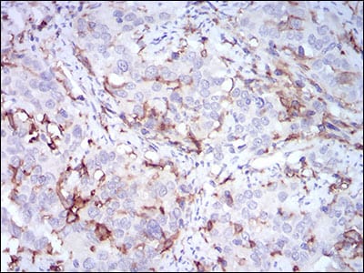 Figure 4: Immunohistochemical analysis of paraffin-embedded cervical cancer tissues using CD14 mouse mAb with DAB staining.