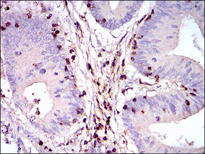 Figure 4: Immunohistochemical analysis of paraffin-embedded colon cancer tissues using PTPRC mouse mAb with DAB staining.