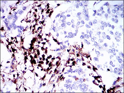 Figure 3: Immunohistochemical analysis of paraffin-embedded breast cancer tissues using PTPRC mouse mAb with DAB staining.