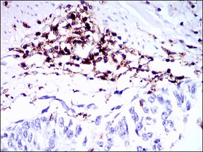 Figure 4: Immunohistochemical analysis of paraffin-embedded esophageal cancer tissues using PTPRC mouse mAb with DAB staining.