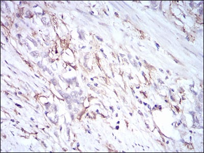Figure 6: Immunohistochemical analysis of paraffin-embedded stomach cancer tissues using CD14 mouse mAb with DAB staining.