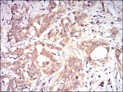Figure 5: Immunohistochemical analysis of paraffin-embedded cervical cancer tissues using B2M mouse mAb with DAB staining.