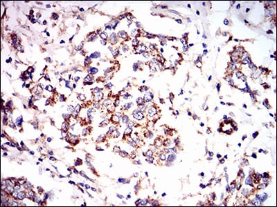 Figure 4: Immunohistochemical analysis of paraffin-embedded breast cancer tissues using PRKAG1 mouse mAb with DAB staining.