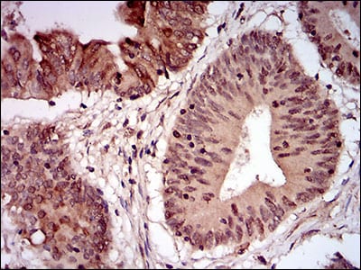 Figure 7: Immunohistochemical analysis of paraffin-embedded colon cancer tissues using NBN mouse mAb with DAB staining.