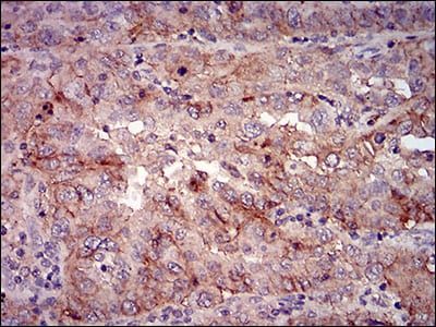 Figure 5: Immunohistochemical analysis of paraffin-embedded endometrial cancer tissues using mSplunc2 mouse mAb with DAB staining.