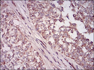 Figure 4: Immunohistochemical analysis of paraffin-embedded bladder cancer tissues using NT5E mouse mAb with DAB staining.