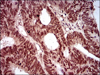 Figure 7: Immunohistochemical analysis of paraffin-embedded rectum cancer tissues using NBN mouse mAb with DAB staining.