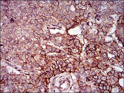 Figure 4: Immunohistochemical analysis of paraffin-embedded prostate cancer tissues using mSplunc2 mouse mAb with DAB staining.