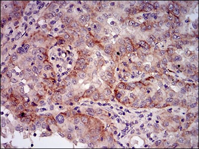 Figure 5: Immunohistochemical analysis of paraffin-embedded endometrial cancer tissues using mSplunc2 mouse mAb with DAB staining.