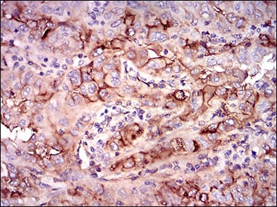 Figure 5: Immunohistochemical analysis of paraffin-embedded endometrial cancer tissues using NT5E mouse mAb with DAB staining.