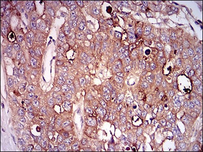 Figure 6: Immunohistochemical analysis of paraffin-embedded esophageal cancer tissues using NT5E mouse mAb with DAB staining.