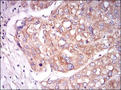 Figure 4: Immunohistochemical analysis of paraffin-embedded liver cancer tissues using TIE1 mouse mAb with DAB staining.