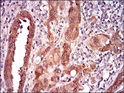 Figure 5: Immunohistochemical analysis of paraffin-embedded endometrial cancer tissues using CDKN2A mouse mAb with DAB staining.