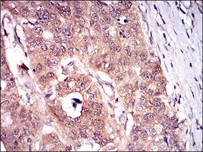 Figure 6: Immunohistochemical analysis of paraffin-embedded esophageal cancer tissues using CDKN2A mouse mAb with DAB staining.