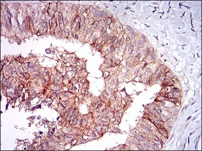 Figure 4: Immunohistochemical analysis of paraffin-embedded ovarian cancer tissues using TIE1 mouse mAb with DAB staining.