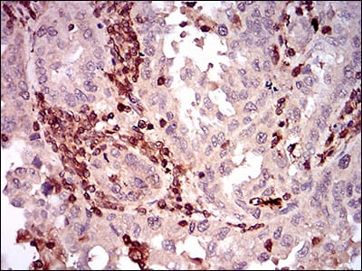 Figure 6: Immunohistochemical analysis of paraffin-embedded endometrial cancer tissues using CD68 mouse mAb with DAB staining.