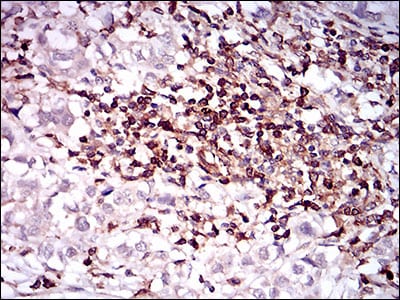 Figure 7: Immunohistochemical analysis of paraffin-embedded bladder cancer tissues using CD68 mouse mAb with DAB staining.