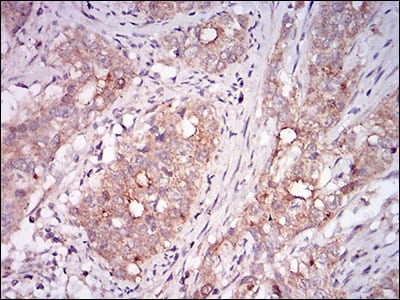 Figure 2: Immunohistochemical analysis of paraffin-embedded cervical cancer tissues using MSTN mouse mAb with DAB staining.