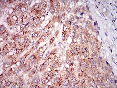 Figure 3: Immunohistochemical analysis of paraffin-embedded liver cancer tissues using MSTN mouse mAb with DAB staining.