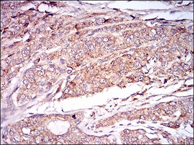 Figure 5: Immunohistochemical analysis of paraffin-embedded prostate cancer tissues using CAMK2G mouse mAb with DAB staining.