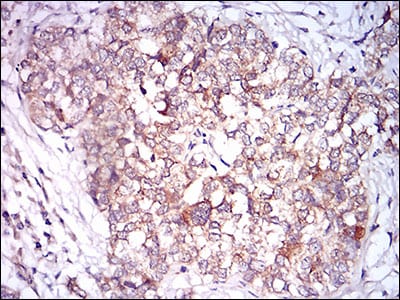Figure 6: Immunohistochemical analysis of paraffin-embedded bladder cancer tissues using CAMK2G mouse mAb with DAB staining.