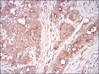 Figure 4: Immunohistochemical analysis of paraffin-embedded cervical cancer tissues using MSTN mouse mAb with DAB staining.