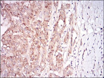 Figure 5: Immunohistochemical analysis of paraffin-embedded liver cancer tissues using MSTN mouse mAb with DAB staining.