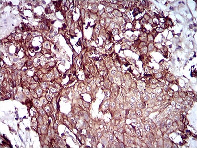 Figure 5: Immunohistochemical analysis of paraffin-embedded esophageal cancer tissues using DSG3 mouse mAb with DAB staining.