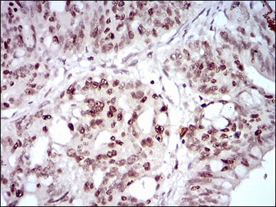 Figure 3: Immunohistochemical analysis of paraffin-embedded rectum cancer tissues using HOXB4 mouse mAb with DAB staining.