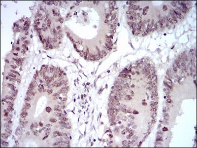 Figure 4: Immunohistochemical analysis of paraffin-embedded colon cancer tissues using HOXB4 mouse mAb with DAB staining.