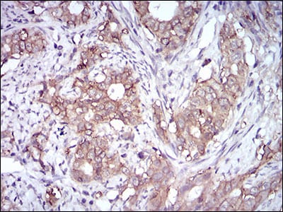 Figure 5: Immunohistochemical analysis of paraffin-embedded cervical cancer tissues using EPCAM mouse mAb with DAB staining.