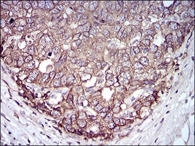 Figure 6: Immunohistochemical analysis of paraffin-embedded esophageal cancer tissues using EPCAM mouse mAb with DAB staining.