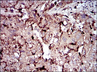 Figure 4: Immunohistochemical analysis of paraffin-embedded liver cancer tissues using PLA2G12A mouse mAb with DAB staining.