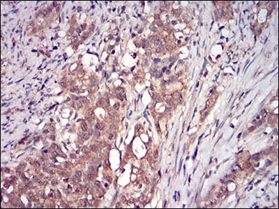 Figure 5: Immunohistochemical analysis of paraffin-embedded cervical cancer tissues using DDIT3 mouse mAb with DAB staining.