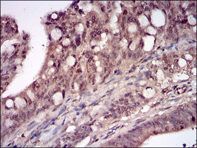Figure 6: Immunohistochemical analysis of paraffin-embedded rectum cancer tissues using DDIT3 mouse mAb with DAB staining.