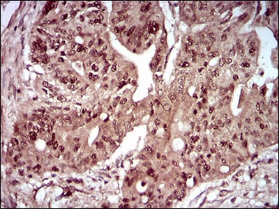 Figure 6: Immunohistochemical analysis of paraffin-embedded rectum cancer tissues using DAPK3 mouse mAb with DAB staining.