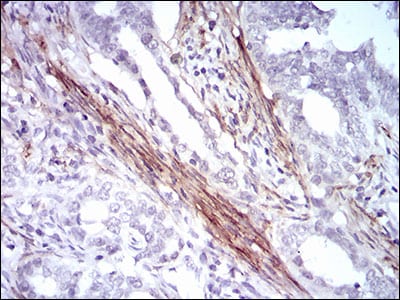 Figure 3: Immunohistochemical analysis of paraffin-embedded cervical cancer tissues using CNN1 mouse mAb with DAB staining.