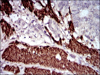 Figure 4: Immunohistochemical analysis of paraffin-embedded esophageal cancer tissues using CNN1 mouse mAb with DAB staining.