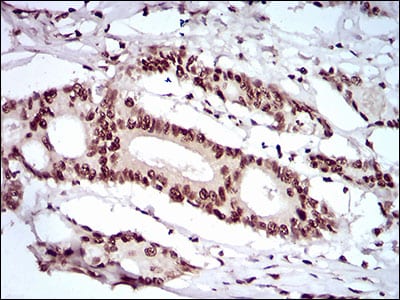 Figure 5: Immunohistochemical analysis of paraffin-embedded colon cancer tissues using KHDRBS2 mouse mAb with DAB staining.