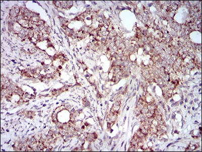 Figure 5: Immunohistochemical analysis of paraffin-embedded cervical cancer tissues using GAB2 mouse mAb with DAB staining.