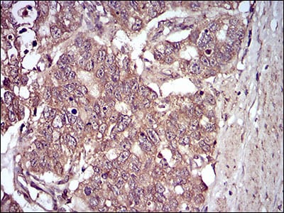 Figure 6: Immunohistochemical analysis of paraffin-embedded esophageal cancer tissues using GAB2 mouse mAb with DAB staining.