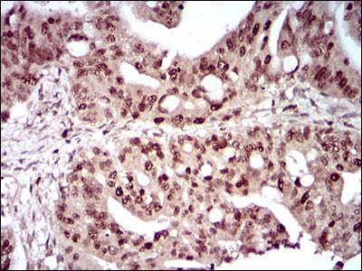 Figure 4: Immunohistochemical analysis of paraffin-embedded rectum cancer tissues using DAPK3 mouse mAb with DAB staining.